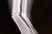 Lower leg fracture at the park together (of archives).